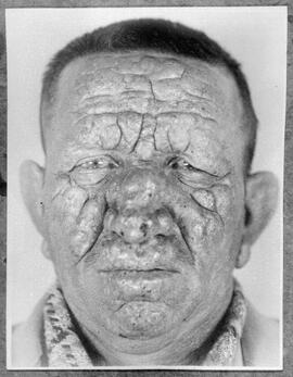 Fotografia "Sanatório 'Padre Bento', São Paulo, reportagem com leprosos, Reportagem Geral" ([Local n/d] , [Data n/d]) [negativo]. / Fotógrafo(a): Jean Manzon.  -- ITEM-0003.